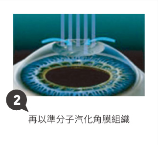 SFAIR TransPRK近視雷射2